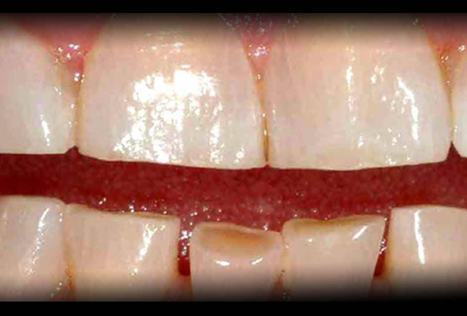 The New Paradigm of Bruxism Arrowhead Dental Laboratory