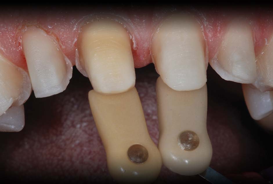 Shade Taking Arrowhead Dental Laboratory