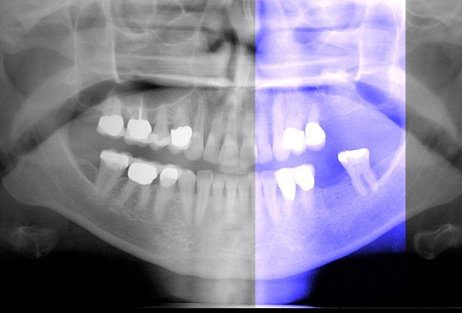 Socket Preservation Arrowhead Dental Laboratory