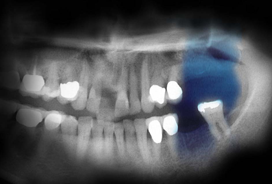 Socket Preservation 2.0 Arrowhead Dental Laboratory