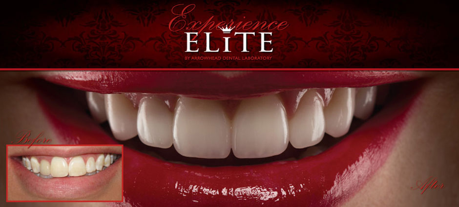 Elite Dental Restoration Emax Crowns