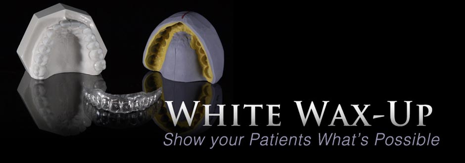 Diagnostic White Dental Wax-Up