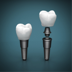 dentalimplants